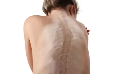 Scoliosis