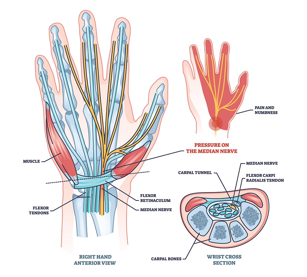 Chiropractor for Carpal Tunnel | Carpal Tunnel Pain Relief